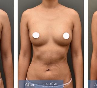 療程效果因人而異，上圖為B罩杯產後女性在做完自體脂肪隆乳之後​手術後一個月、手術後六個月成效